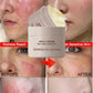 Facial Redness Repair Cream Improve Sensitive Skin Dryness Moisturizer Hydrating Sooth Lotion Removal Rosacea Korean Cosmetics - Brocelles